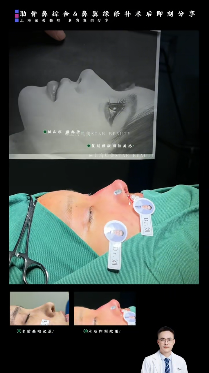 Kết hợp xương sườn mũi + sửa chữa v&agrave;nh mũi ngay sau phẫu thuật: một phương ph&aacute;p kết hợp "hỗ trợ mũi mũi + kh&ocirc;i phục v&agrave;nh mũi"
