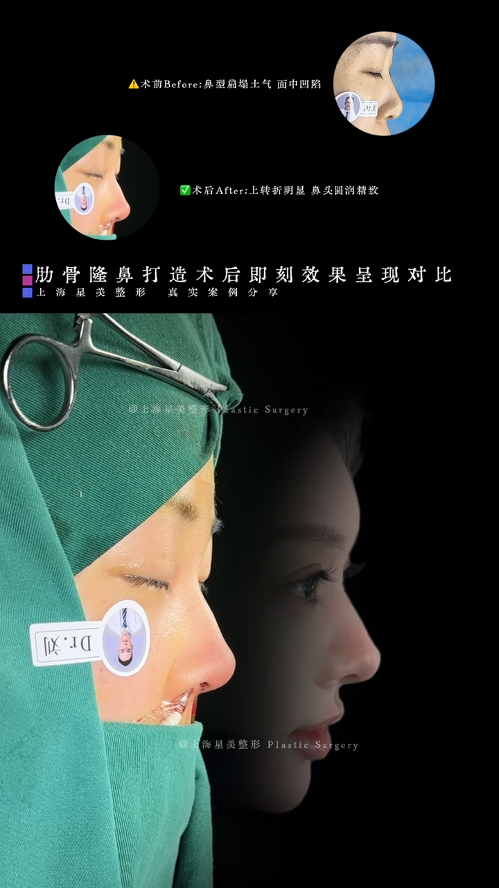 Kết quả ngay lập tức sau phẫu thuật n&acirc;ng mũi sườn