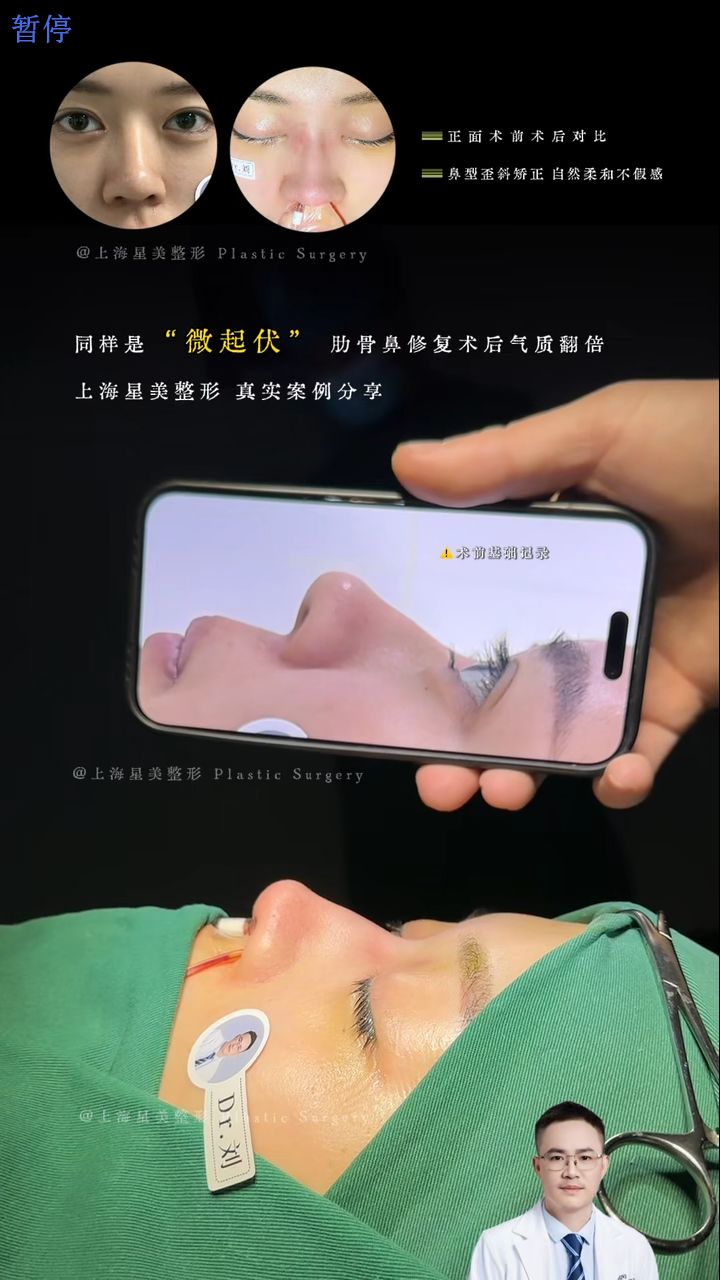 Sửa chữa mũi sườn nhỏ